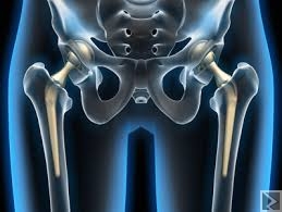 Image principale de Traitement par prothèse de lâ€™arthrose de la hanche