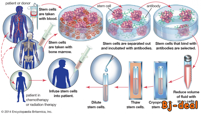 Image principale de La greffe de moelle osseuse