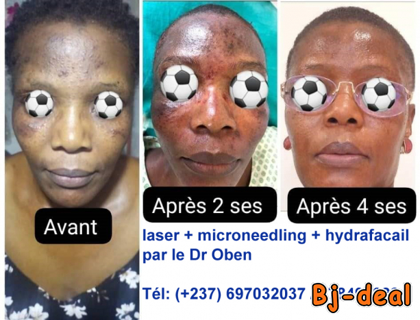 Image principale de Rajeunissement du visage au laser