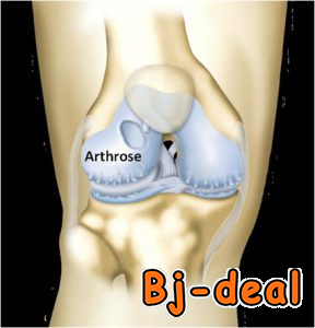 Image principale de Arthrose du genou