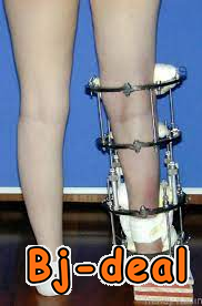 Image principale de CHIRURGIE ALLONGEMENT DES JAMBES