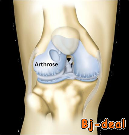 Image principale de Traitement par prothèse arthrose du genou