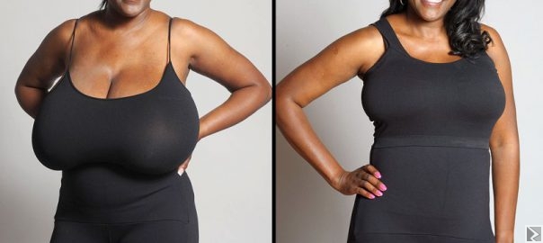 Image principale de RÉDUCTION MAMMAIRE