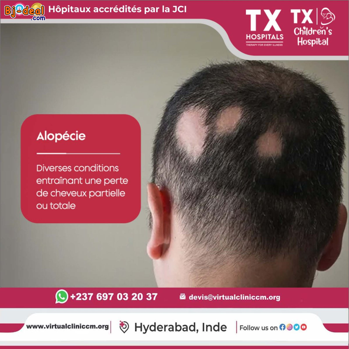 Image principale de Alopécie traitement en Inde