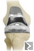 Main image of Prothèse de lâ€™arthrose du genou