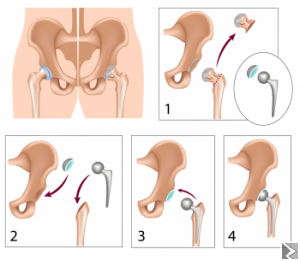 Main image of Prothèse de lâ€™arthrose de la hanche