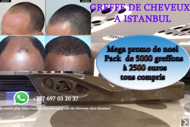 Main image of Implants de cheveux à  Istanbul