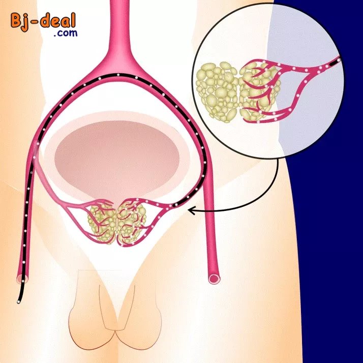 Main image of Embolisation de la Prostate en Afrique Libérez-vous de l Adénome