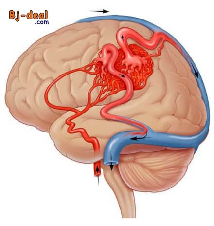 Main image of Les malformations vasculaires cérébrales C est quoi