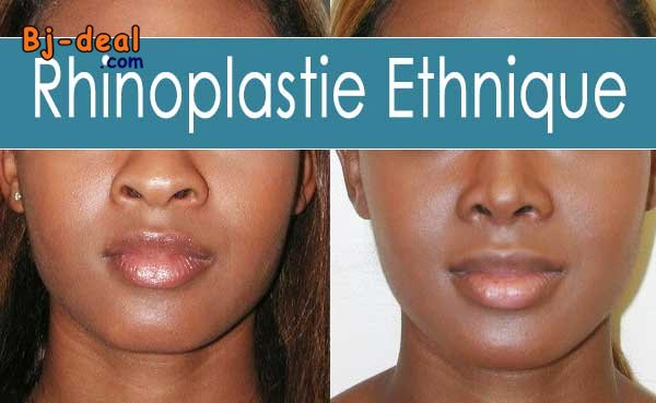 Main image of Rhinoplastie à Yaoundé