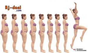 Main image of Sleeve gastrique en Inde Tunisie Turquie Maroc Cameroun