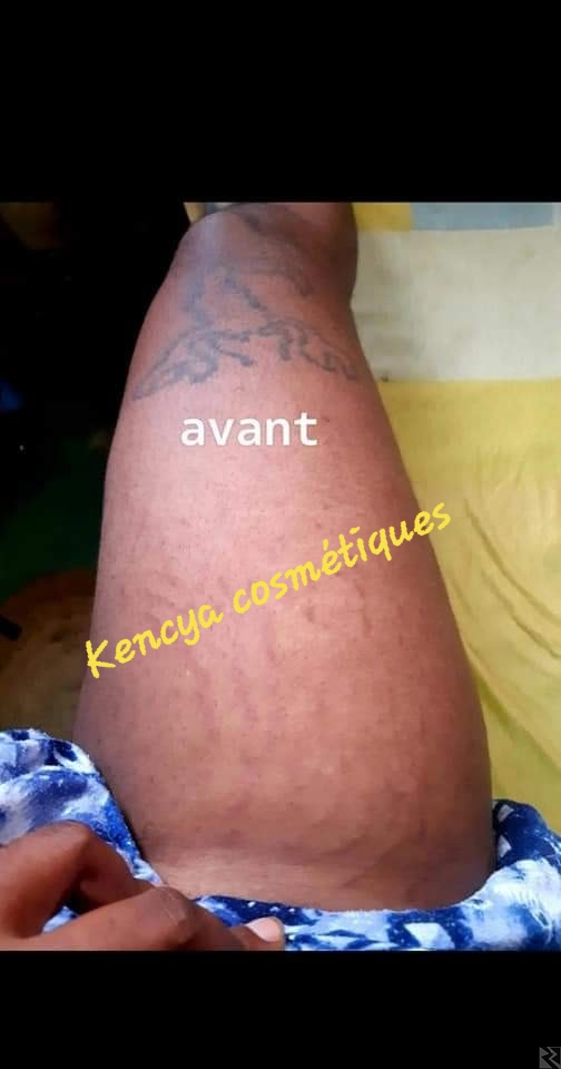 Image principale de Produit des vergetures