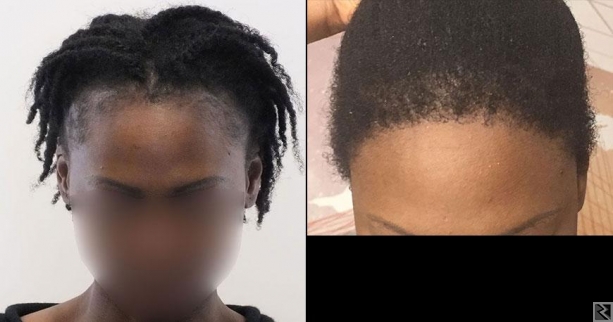 Main image of Greffe de cheveux au Cameroun