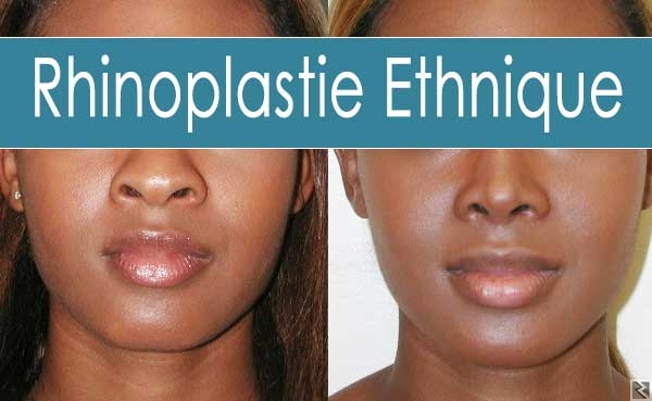 Main image of RHINOPLASTIE
