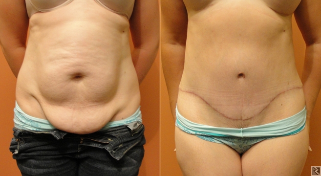 Image principale de Abdominoplastie