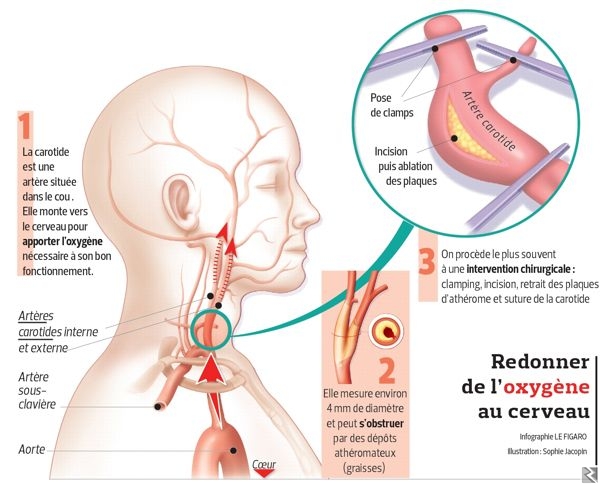 Image principale de Operation anévrisme