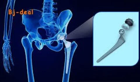Main image — Souffrez-vous d arthrose de la hanche