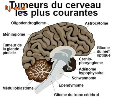 Image principale — Vous souffrez d une Tumeur au Cerveau